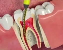 Root Canal Treatment in Delhi