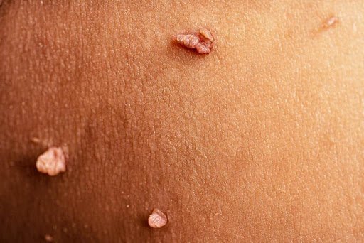 How to get rid of skin tags